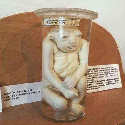 Neugeborenes mit Anencephalus im Reagenzglas